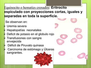 Equinocito o hematíes crenados: Eritrocito
espiculado con proyecciones cortas, iguales y
separadas en toda la superficie.
Se observan en:
 Uremia severa
 Hepatopatías neonatales
 Deficit de potasio en el globulo rojo
 Transfusiones con sangre
envejecida
 Déficit de Piruvato quinasa
 Carcinoma de estómago y Úlceras
sangrantes.
 