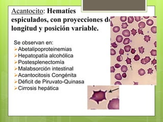 Acantocito: Hematíes
espiculados, con proyecciones de
longitud y posición variable.
Se observan en:
Abetalipoproteinemias
Hepatopatía alcohólica
Postesplenectomía
Malabsorción intestinal
Acantocitosis Congénita
Déficit de Piruvato-Quinasa
Cirrosis hepática
 