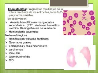Esquistocitos: Fragmentos resultantes de la
rotura mecánica de los eritrocitos, tamaño 2-3
µm y forma variable.
Se observan en:
 Anemia hemolítica microangiopática
secundaria a: (PTT , síndrome hemolítico
urémico, Hemoglobinuria de la marcha
 Hemangioma cavernoso
No hematológicas
 Hemólisis por válvulas cardíacas
 Quemados graves
 Eclampsias y crisis hipertensiva
 carcinomas
 Vasculitis
 Glomeruronefritis
 CID
 