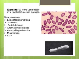 Eliptocito: Su forma varía desde
oval (ovalocito) a elipse alargado.
Se observan en:
 Eliptocitosis hereditaria
 Talasemia
 Déficit de hierro
 Anemias mieloptísicas
 Anemia Megaloblástica
 Mielofibrosis
 SMP
 