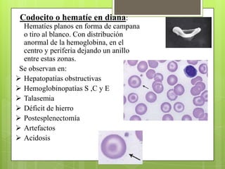 Codocito o hematíe en diana:
Hematíes planos en forma de campana
o tiro al blanco. Con distribución
anormal de la hemoglobina, en el
centro y periferia dejando un anillo
entre estas zonas.
Se observan en:
 Hepatopatías obstructivas
 Hemoglobinopatías S ,C y E
 Talasemia
 Déficit de hierro
 Postesplenectomía
 Artefactos
 Acidosis
 