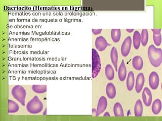 Dacriocito (Hematíes en lágrima):
Hematíes con una sola prolongación,
en forma de raqueta o lágrima.
Se observa en:
 Anemias Megaloblásticas
 Anemias ferropénicas
 Talasemia
 Fibrosis medular
 Granulomatosis medular
 Anemias Hemolíticas Autoinmunes
 Anemia mieloptísica
 TB y hematopoyesis extramedular.
 