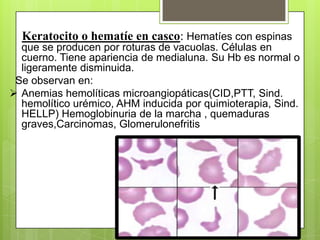 Keratocito o hematíe en casco: Hematíes con espinas
que se producen por roturas de vacuolas. Células en
cuerno. Tiene apariencia de medialuna. Su Hb es normal o
ligeramente disminuida.
Se observan en:
 Anemias hemolíticas microangiopáticas(CID,PTT, Sind.
hemolítico urémico, AHM inducida por quimioterapia, Sind.
HELLP) Hemoglobinuria de la marcha , quemaduras
graves,Carcinomas, Glomerulonefritis
 
