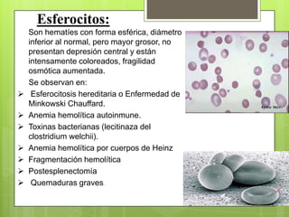 Esferocitos:
Son hematíes con forma esférica, diámetro
inferior al normal, pero mayor grosor, no
presentan depresión central y están
intensamente coloreados, fragilidad
osmótica aumentada.
Se observan en:
 Esferocitosis hereditaria o Enfermedad de
Minkowski Chauffard.
 Anemia hemolítica autoinmune.
 Toxinas bacterianas (lecitinaza del
clostridium welchii).
 Anemia hemolítica por cuerpos de Heinz
 Fragmentación hemolítica
 Postesplenectomía
 Quemaduras graves.
 