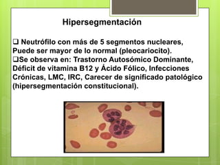Hipersegmentación
 Neutrófilo con más de 5 segmentos nucleares,
Puede ser mayor de lo normal (pleocariocito).
Se observa en: Trastorno Autosómico Dominante,
Déficit de vitamina B12 y Ácido Fólico, Infecciones
Crónicas, LMC, IRC, Carecer de significado patológico
(hipersegmentación constitucional).
 