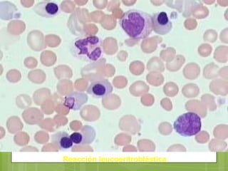 Reacción leucoeritroblástica
 