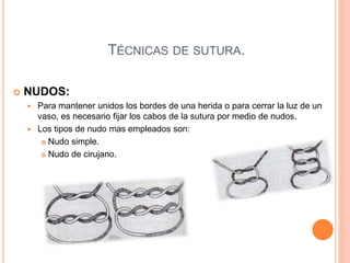 TÉCNICAS DE SUTURA.
 NUDOS:
 Para mantener unidos los bordes de una herida o para cerrar la luz de un
vaso, es necesario fijar los cabos de la sutura por medio de nudos.
 Los tipos de nudo mas empleados son:
 Nudo simple.
 Nudo de cirujano.
 