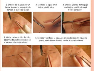 1. Entrada de la aguja por un
borde formando un ángulo de
90º con el plano de la piel.
2. Salida de la aguja en el
tejido subdérmico.
3. Entrada y salida de la aguja
en el tejido subdérmico del
borde contrario.
5. Visión del recorrido del hilo,
observándose el nudo inicial en
el extremo distal del mismo.
6. Entrada y salida de la aguja, en ambos bordes del siguiente
punto, realizado de manera similar al punto anterior.
 