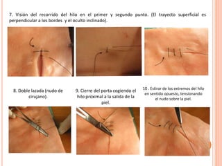 7. Visión del recorrido del hilo en el primer y segundo punto. (El trayecto superficial es
perpendicular a los bordes y el oculto inclinado).
9. Cierre del porta cogiendo el
hilo proximal a la salida de la
piel.
10 . Estirar de los extremos del hilo
en sentido opuesto, tensionando
el nudo sobre la piel.
8. Doble lazada (nudo de
cirujano).
 