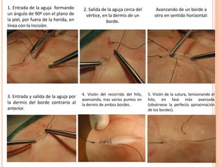1. Entrada de la aguja formando
un ángulo de 90º con el plano de
la piel, por fuera de la herida, en
línea con la incisión.
2. Salida de la aguja cerca del
vértice, en la dermis de un
borde.
Avanzando de un borde a
otro en sentido horizontal:
3. Entrada y salida de la aguja por
la dermis del borde contrario al
anterior.
4. Visión del recorrido del hilo,
avanzando, tras varios puntos en
la dermis de ambos bordes.
5. Visión de la sutura, tensionando el
hilo, en fase más avanzada
(obsérvese la perfecta aproximación
de los bordes).
 