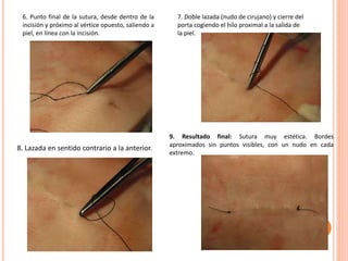 6. Punto final de la sutura, desde dentro de la
incisión y próximo al vértice opuesto, saliendo a
piel, en línea con la incisión.
7. Doble lazada (nudo de cirujano) y cierre del
porta cogiendo el hilo proximal a la salida de
la piel.
8. Lazada en sentido contrario a la anterior.
9. Resultado final: Sutura muy estética. Bordes
aproximados sin puntos visibles, con un nudo en cada
extremo.
 