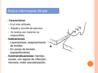  Características
 Es el más utilizado.
 Rápido y sencillo de ejecutar.
 Se realiza con material no
reabsorbible.
 Indicaciones
 Laceraciones, reaproximación
de bordes.
 En zonas de tensión,
supraarticulares.
 Contraindicaciones: heridas
sucias, con signos de infección,
necrosis, mala vascularización.
Sutura interrumpida Simple
 