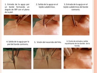 1. Entrada de la aguja por
un borde formando un
ángulo de 90º con el plano
de la piel.
2. Salida de la aguja en el
tejido subdérmico.
3. Entrada de la aguja en el
tejido subdérmico del borde
contrario.
4. Salida de la aguja por la
piel del borde contrario.
5. Visión del recorrido del hilo. 6. Punto de entrada y salida
equidistante de los bordes de la
herida.
 