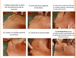 7. Doble lazada sobre el porta
del hilo proximal (nudo de
cirujano).
8. Cierre del porta cogiendo
el hilo distal.
9. Estirar de los extremos del hilo
en sentido opuesto, tensionando
el nudo sobre la piel.
10. Lazada en sentido contrario
a la anterior.
11. Visión de un punto simple.
12. Resultado final: Bordes
evertidos, puntos equidistantes de
los bordes de la herida y nudos a un
lado de la herida.
 