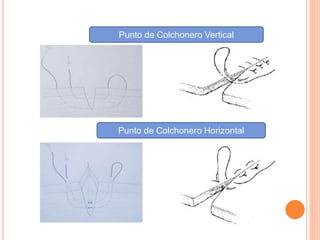 Punto de Colchonero Vertical
Punto de Colchonero Horizontal
 