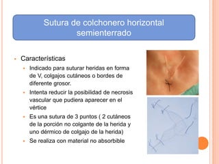  Características
 Indicado para suturar heridas en forma
de V, colgajos cutáneos o bordes de
diferente grosor.
 Intenta reducir la posibilidad de necrosis
vascular que pudiera aparecer en el
vértice
 Es una sutura de 3 puntos ( 2 cutáneos
de la porción no colgante de la herida y
uno dérmico de colgajo de la herida)
 Se realiza con material no absorbible
Sutura de colchonero horizontal
semienterrado
 