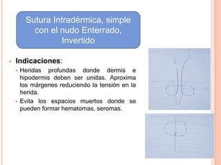  Indicaciones:
 Heridas profundas donde dermis e
hipodermis deben ser unidas. Aproxima
los márgenes reduciendo la tensión en la
herida.
 Evita los espacios muertos donde se
pueden formar hematomas, seromas.
Sutura Intradérmica, simple
con el nudo Enterrado,
Invertido
 