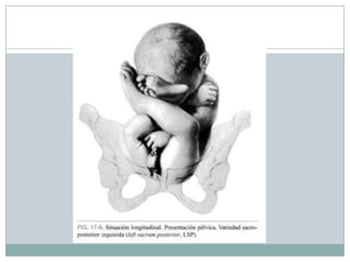 TRANSVERS
AL
Punto de referencia es el
Acromion del feto en
relación a la pelvis materna.
Situación transversa
con dorso s...