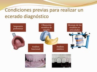 Condiciones previas para realizar un
ecerado diagnóstico
Impresión
preliminar
Obtención
modelos de
estudio
Montaje de los
modelos en
articulador
Análisis
funcional
Análisis
estético
 
