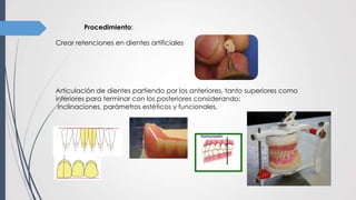 Procedimiento:
Crear retenciones en dientes artificiales
Articulación de dientes partiendo por los anteriores, tanto superiores como
inferiores para terminar con los posteriores considerando:
Inclinaciones, parámetros estéticos y funcionales.
 