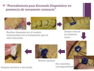 +
Realizar desgastes en el modelo
relacionados con el tratamiento que se
está evaluando.
Gotear cera en
las distintas
caras
Dar anatomía
correspondiente
Retirar excesos
Limpiar, terminar y dar brillo
“Procedimiento para Encerado Diagnóstico: en
presencia de remanente coronario”
 