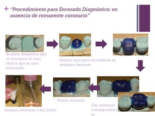 +
Limpiar, terminar y dar brillo
Retirar excesos
Dar anatomía
correspondien
te
Realizar desgastes que
se acerquen al caso
clínico que se está
evaluando
Gotear cera para reconstituir el
volumen dentario
“Procedimiento para Encerado Diagnóstico: en
ausencia de remanente coronario”
 