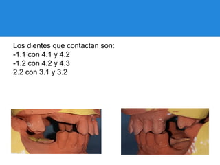 Los dientes que contactan son:
-1.1 con 4.1 y 4.2
-1.2 con 4.2 y 4.3
2.2 con 3.1 y 3.2
 