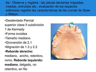 6a.- Observe y registre : las piezas dentarias migradas,
rotadas, extruidas etc., evaluación de los espacios
edéntulos registre las características de las curvas de Spee
y Wilson.
•Desdentado Parcial
superior clase II subdivisión
1 de Kennedy
•Forma ovoidea
•Tamaño mediano
•Giroversión de 2.1
•Migración de 1.3 y 2.2
•Reborde derecho:
mediano, ancho, retentivo,
romo. Reborde izquierdo:
mediano, delgado, no
retentivo, en filo
 
