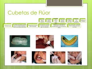 Cubetas de Flúor
Elección
de la
Cubeta
Prefabricada
confeccionadas a partir
de un molde individual
de las arcadas dentarias
Presentar la forma
de la arcada
Favorecer un buen
contacto entre el
gel y los dientes
Asegurar un hermetismo
suficiente a nivel de los
bordes para que no entre la
saliva
Ser cómoda y permitir
tratar ambas arcadas
a la vez
Limpieza
de los
Dientes
Lavado
de la
boca
con
Agua
Secado
de los
Dientes
Cargar la
Cubeta
con Gel
Colocar
la
cubeta
en boca
Retirar la
Cubeta
 