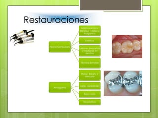 Restauraciones
Resina Compuesta
Matriz orgánica
BIS GMA + Relleno
inorgánico
Estética
Lesiones pequeñas
y medianas en
dentina
Técnica Sensible
Amalgama
Plata + Estaño +
Mercurio
Larga durabilidad
Bajo costo
No estética
 
