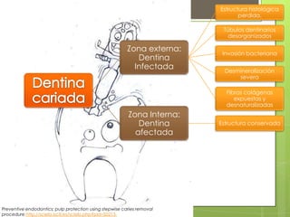 Zona externa:
Dentina
Infectada
Estructura histológica
perdida.
Túbulos dentinarios
desorganizados
Invasión bacteriana
Desmineralización
severa
Fibras colágenas
expuestas y
desnaturalizadas
Zona Interna:
Dentina
afectada
Estructura conservada
Preventive endodontics: pulp protection using stepwise caries removal
procedure http://scielo.isciii.es/scielo.php?pid=S0213-
 