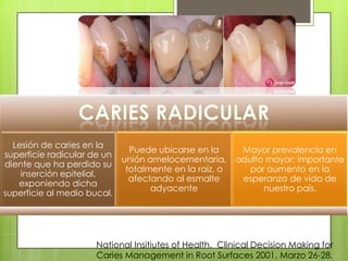 National Insitiutes of Health. Clinical Decision Making for
Caries Management in Root Surfaces 2001, Marzo 26-28.
Lesión de caries en la
superficie radicular de un
diente que ha perdido su
inserción epitelial,
exponiendo dicha
superficie al medio bucal.
Puede ubicarse en la
unión amelocementaria,
totalmente en la raíz, o
afectando al esmalte
adyacente
Mayor prevalencia en
adulto mayor; importante
por aumento en la
esperanza de vida de
nuestro país.
 