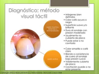 Lesión inactiva,
Detenida o
remineralizada
• Márgenes bien
definidos
• Color café oscuro o
negro
• Superficie suave y/o
brillante
• Duro al sondaje con
presion moderada
• Usualmente no
cubierta de placa
• Puede estar o no
cavitada
Lesión activa
• Color amarillo o café
claro
• Blando o consistencia
de cuero al sondaje
bajo presión suave
• Visiblemente cubierta
de placa
• Cavitación puede o no
estar presente
Cariología clínica: Bases preventivas y restauradoras. Moncada y Urzúa 2008
 