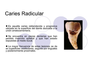 Caries Radicular
 Es aquella caries reblandecida y progresiva
ubicada en la superficie del diente asociada a la
unión amelocementaria.
 Se encuentra en piezas dentarias que han
perdido inserción epitelial y que han estado
expuestas al medio bucal.
 La mayor frecuencia de estas lesiones se da
en superficies vestibulares, seguido por linguales
y posteriormente proximales.
 