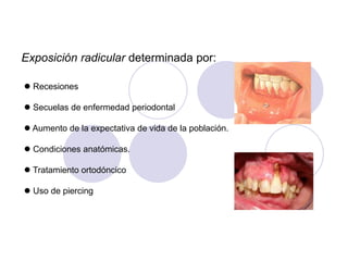 Exposición radicular determinada por:
 Recesiones
 Secuelas de enfermedad periodontal
 Aumento de la expectativa de vida de la población.
 Condiciones anatómicas.
 Tratamiento ortodóncico
 Uso de piercing
 