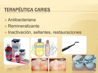 TERAPÉUTICA CARIES
 Antibacteriana
 Remineralizante
 Inactivación, sellantes, restauraciones
 