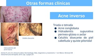 Acné y rosácea - Dermatología de Arenas | PPTX