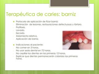 Terapéutica de caries: barniz
 Protocolo de aplicación de flúor barniz:
- Eliminación de lesiones, restauraciones defectuosas y tártaro.
- Profilaxis.
- Lavado.
- Secado.
- Aislamiento relativo.
- Aplicación de barniz.
 Indicaciones al paciente:
- No comer en 3 horas.
- No usar seda dental en 72 horas.
- No cepillar los dientes en las primeras 12 horas.
- Explicar que dientes permanecerán coloridos las primeras
horas.
 