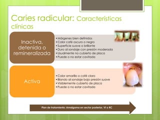 Caries radicular: Características
clínicas
•Márgenes bien definidos
•Color café oscuro o negro
•Superficie suave o brillante
•Duro al sondaje con presión moderada
•Usualmente no cubierto de placa
•Puede o no estar cavitada
Inactiva,
detenida o
remineralizada
•Color amarillo o café claro
•Blando al sondaje bajo presión suave
•Visiblemente cubierto de placa
•Puede o no estar cavitada
Activa
Plan de tratamiento: Amalgama en sector posterior, VI o RC
 