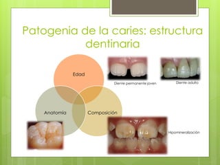 Patogenia de la caries: estructura
dentinaria
Edad
ComposiciónAnatomía
Hipomineralización
Diente adultoDiente permanente joven
 