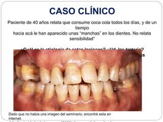 Paciente de 40 años relata que consume coca cola todos los días, y de un
tiempo
hacia acá le han aparecido unas “manchas” en los dientes. No relata
sensibilidad”
¿Cuál es la etiología de estas lesiones? ¿Ud. las trataría?
Si es afirmativa su respuesta, indique con qué material las
restauraría.
CASO CLÍNICO
Dado que no había una imagen del seminario, encontré esta en
internet.
 