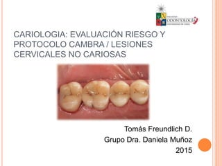 CARIOLOGIA: EVALUACIÓN RIESGO Y
PROTOCOLO CAMBRA / LESIONES
CERVICALES NO CARIOSAS
Tomás Freundlich D.
Grupo Dra. Daniela Muñoz
2015
 