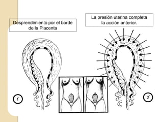 Desprendimiento por el borde
de la Placenta
La presión uterina completa
la acción anterior.
 