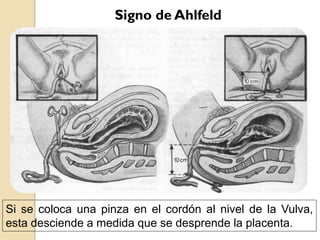 Signo de Ahlfeld
Si se coloca una pinza en el cordón al nivel de la Vulva,
esta desciende a medida que se desprende la placenta.
 