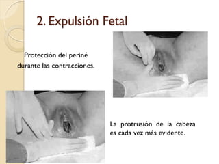 2. Expulsión Fetal
Protección del periné
durante las contracciones.
La protrusión de la cabeza
es cada vez más evidente.
 