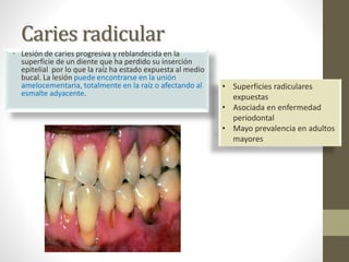 Caries radicular
• Lesión de caries progresiva y reblandecida en la
superficie de un diente que ha perdido su inserción
epitelial por lo que la raíz ha estado expuesta al medio
bucal. La lesión puede encontrarse en la unión
amelocementaria, totalmente en la raíz o afectando al
esmalte adyacente.
• Superficies radiculares
expuestas
• Asociada en enfermedad
periodontal
• Mayo prevalencia en adultos
mayores
 
