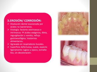 3.EROSIÓN/ CORROSIÓN:
 Disolución dental ocasionada por
ácidos no bacterianos.
 Etiología: factores extrínsecos e
intrínsecos  ácidos exógenos, dieta,
regurgitación o vomito, reflujo
gastroesofágico, trastornos
alimentarios.
 Agravada en respiradores bucales.
 Superficie defectuosa, suave, aspecto
ligeramente rugoso y opaco, esmalte
liso, sin decoloración.
 