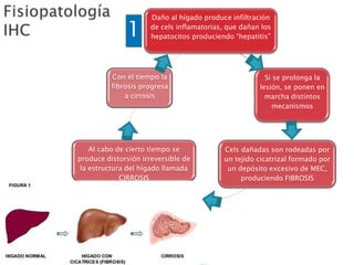 Daño al hígado produce infiltración
de cels inflamatorias, que dañan los
hepatocitos produciendo “hepatitis”
Si se prolonga la
lesión, se ponen en
marcha distintos
mecanismos
Cels dañadas son rodeadas por
un tejido cicatrizal formado por
un depósito excesivo de MEC,
produciendo FIBROSIS
Al cabo de cierto tiempo se
produce distorsión irreversible de
la estructura del hígado llamada
CIRROSIS
Con el tiempo la
fibrosis progresa
a cirrosis
1
 