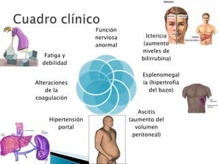 Función
nerviosa
anormal
Ictericia
(aumento
niveles de
bilirrubina)
Esplenomegal
ia (hipertrofia
del bazo)
Ascitis
(aumento del
volumen
peritoneal)
Hipertensión
portal
Alteraciones
de la
coagulación
Fatiga y
debilidad
 