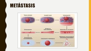 METÁSTASIS
 